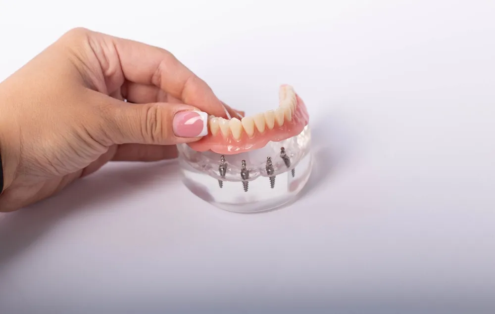 can you eat anything with all four implants