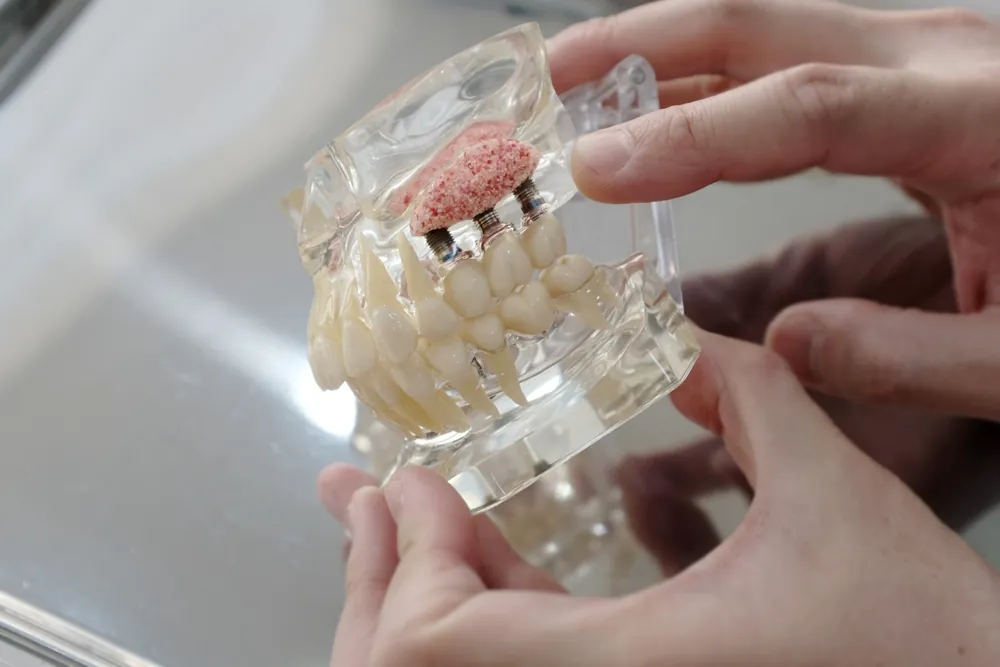 everything you need to know about dental bone grafting