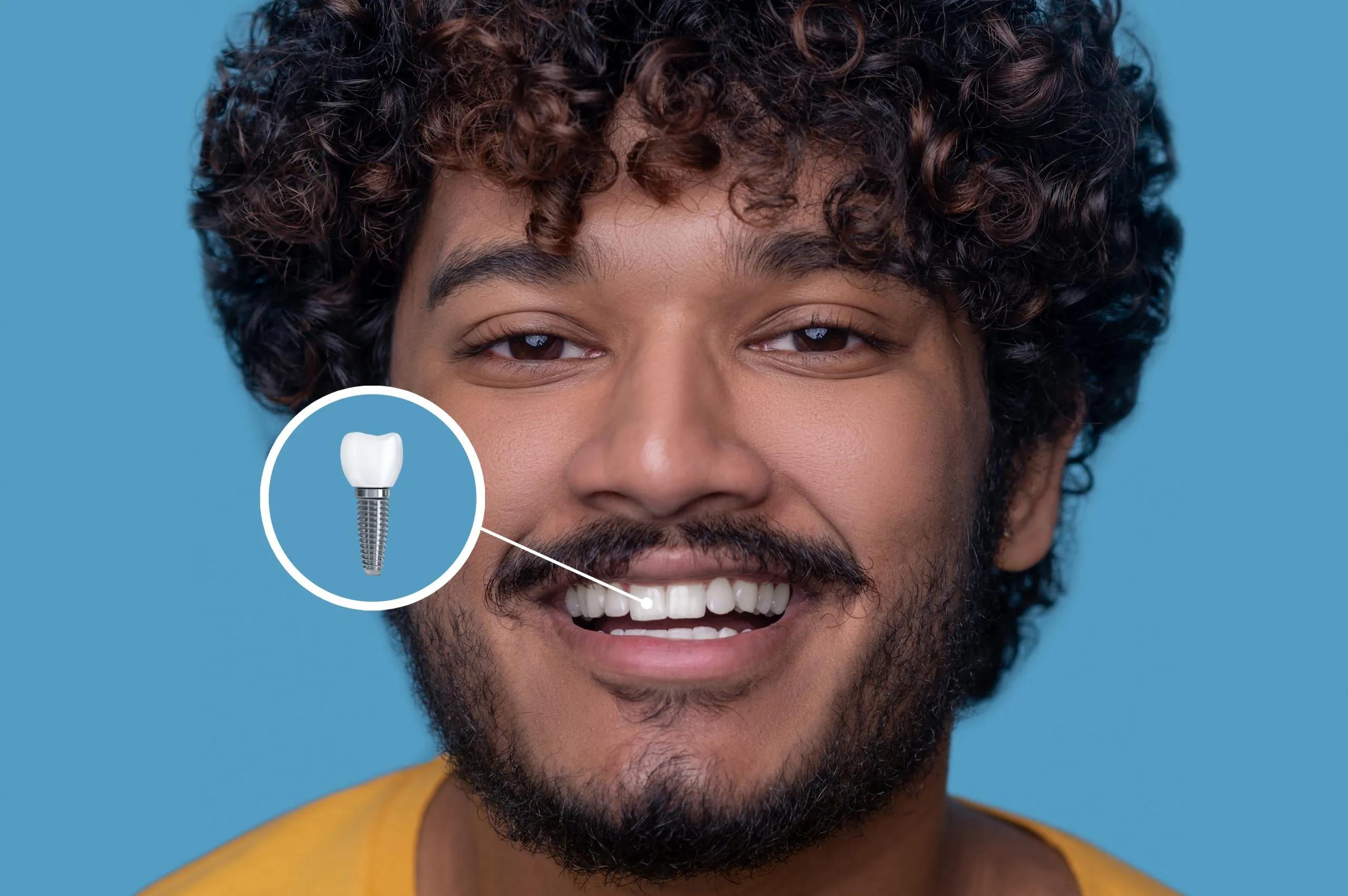 Single Dental Implant
