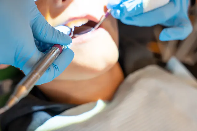 Professional teeth cleaning at My New Teeth