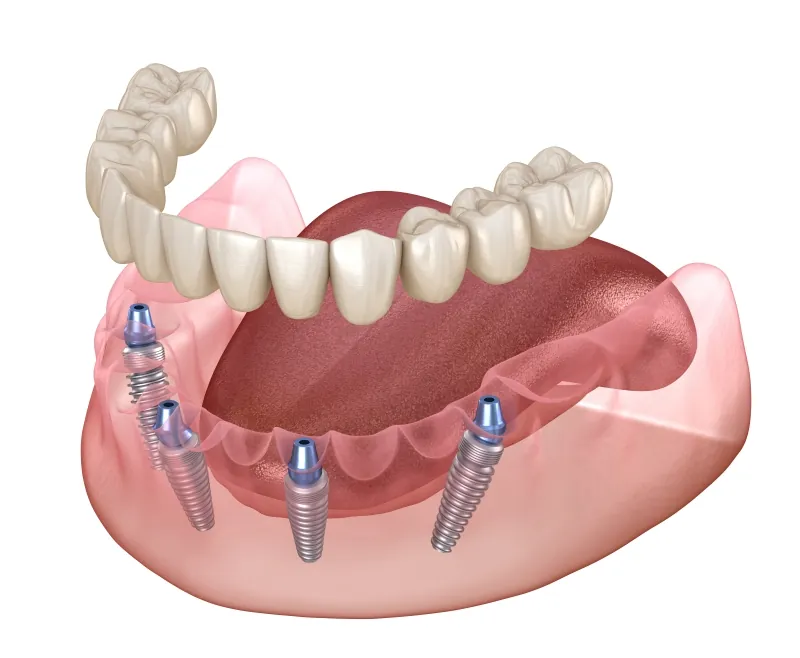 All-on-4 full arch dental implants