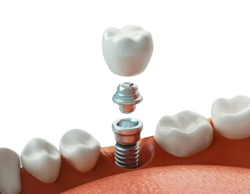 Single dental implant illustration