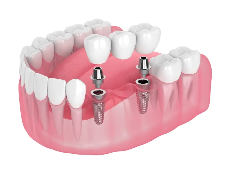 Dental implant bridge