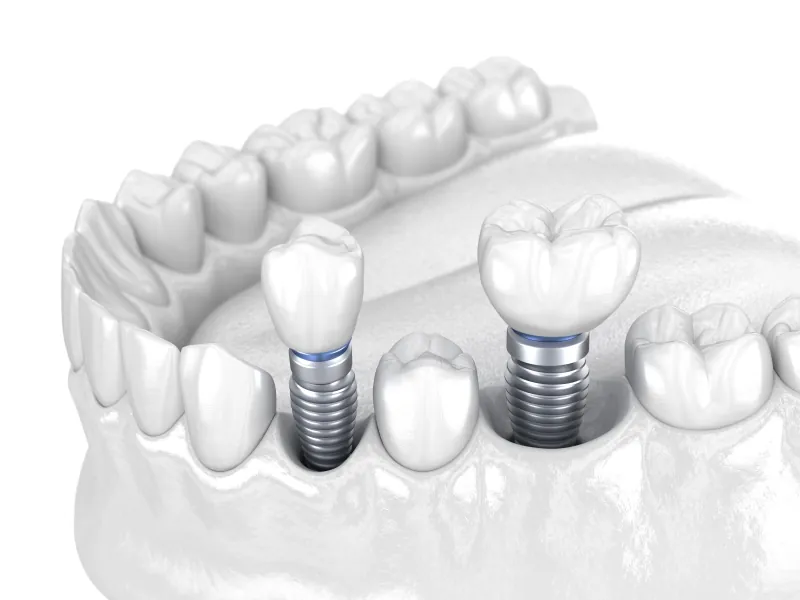 Multiple dental implants