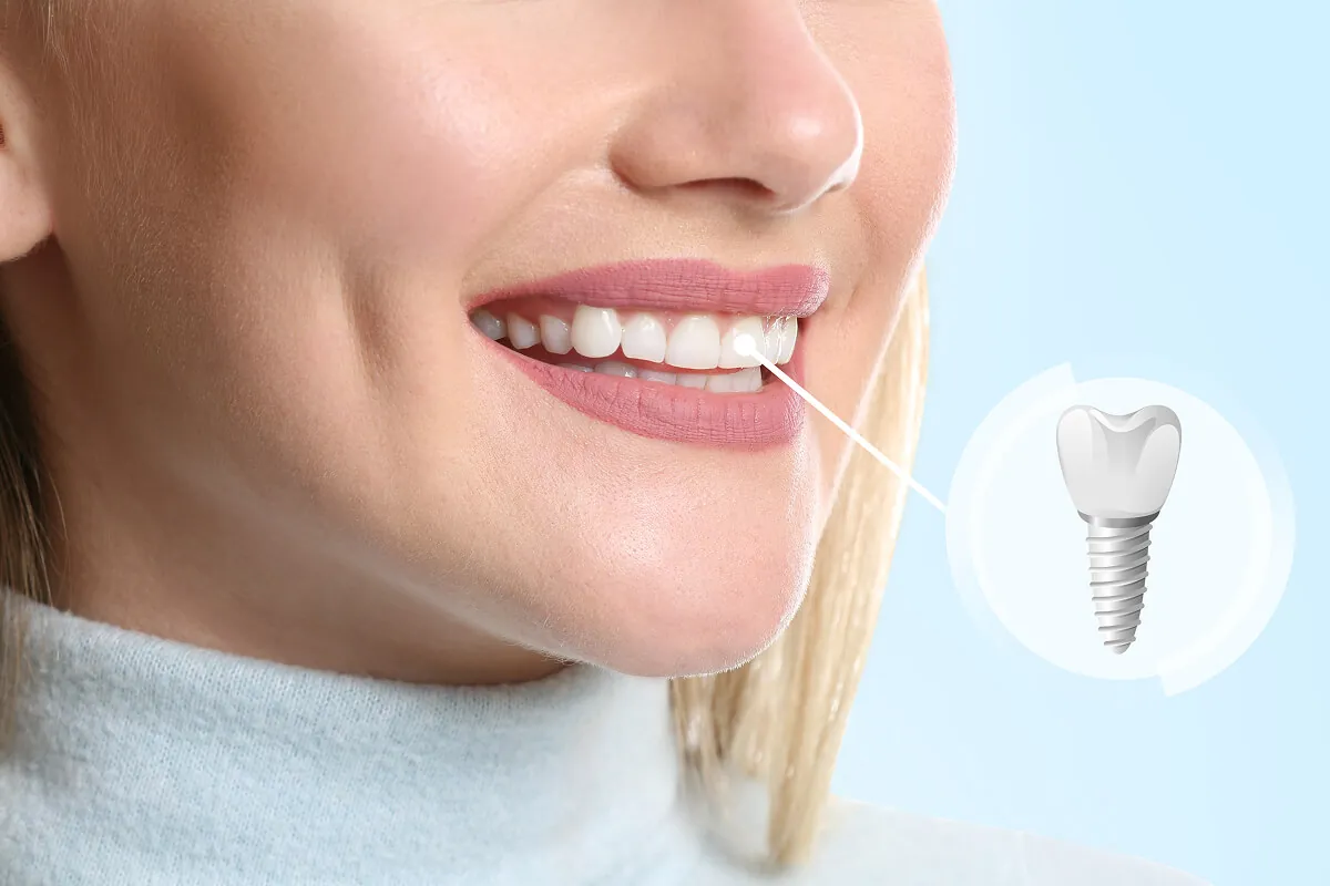 Illustration representing dental implant placement