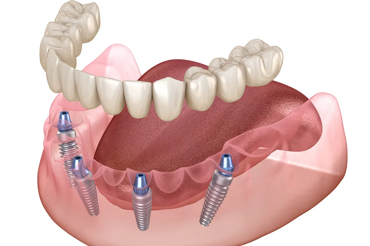 All-on-4 dental implant treatment