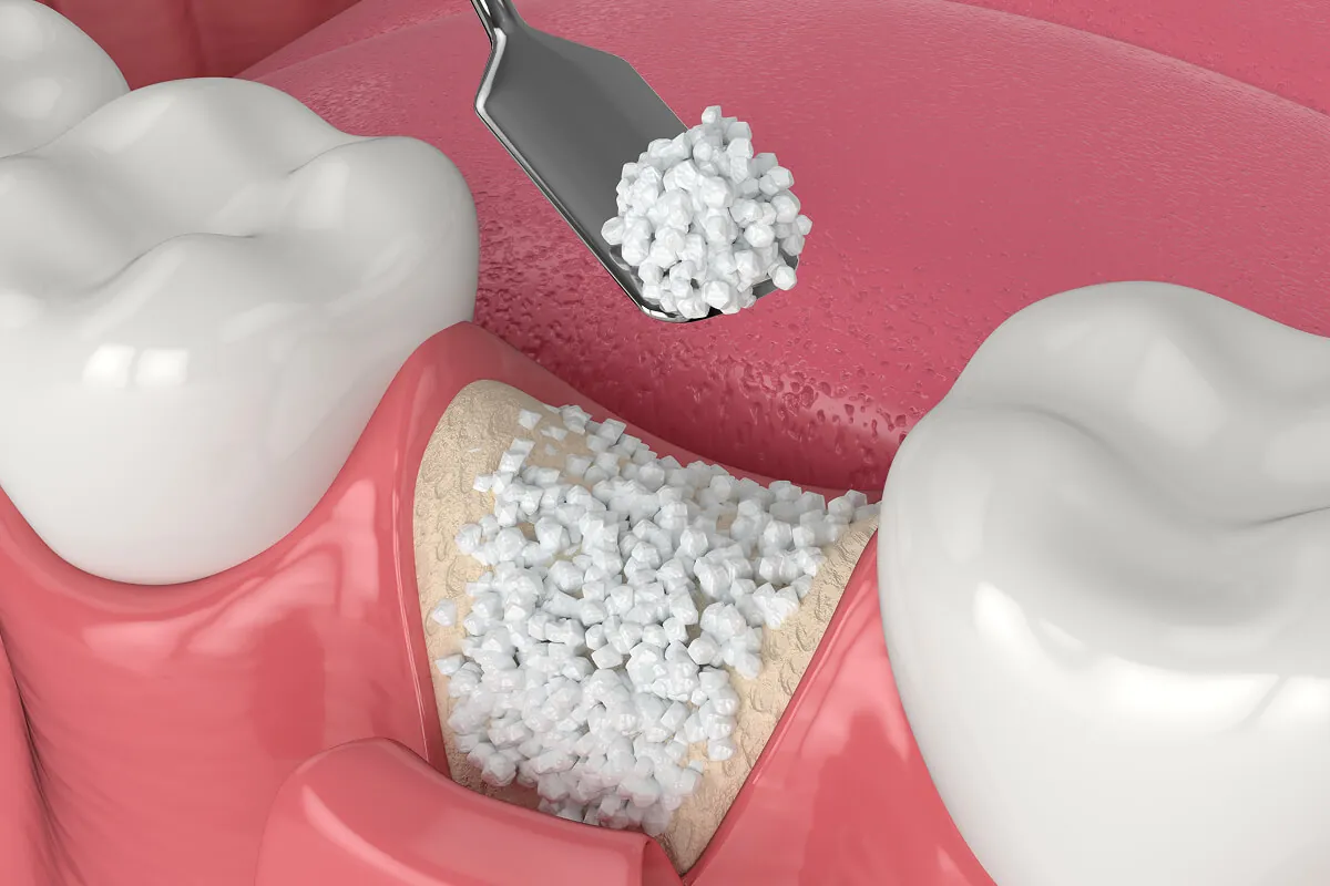 Bone grafting treatment planning