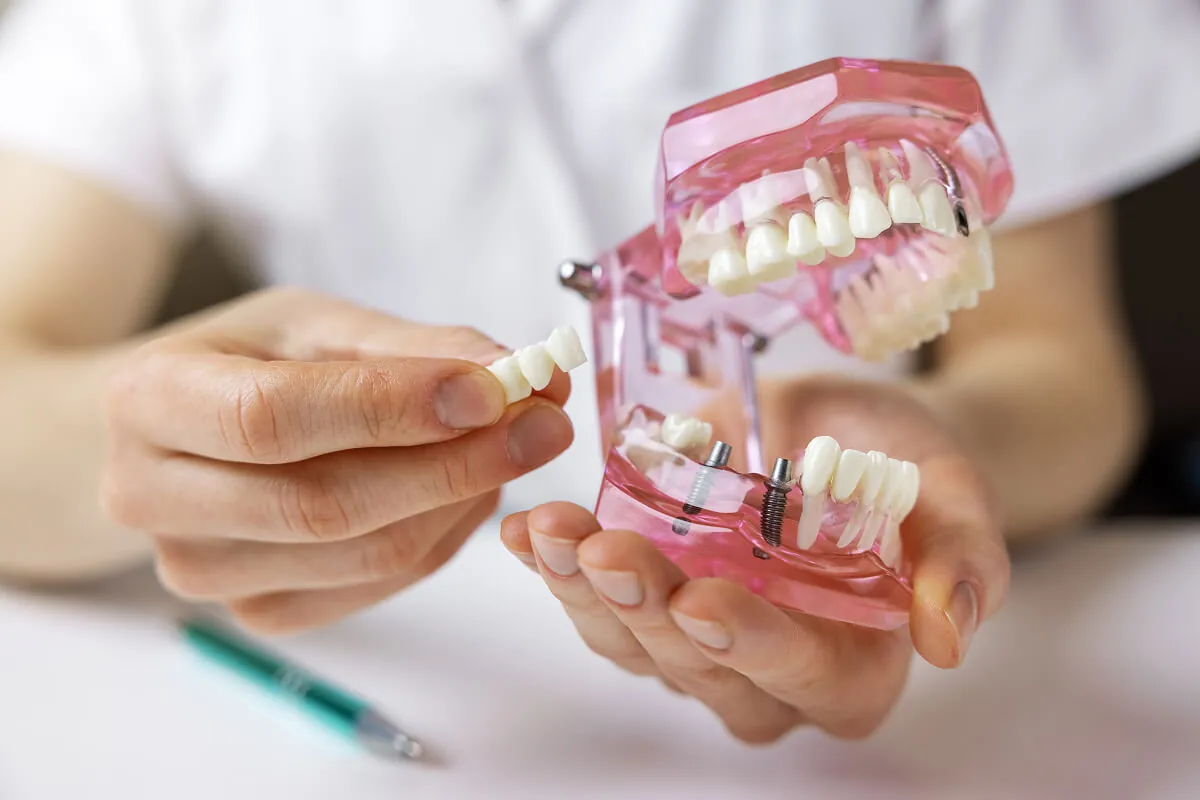 Dental implant bridge treatment