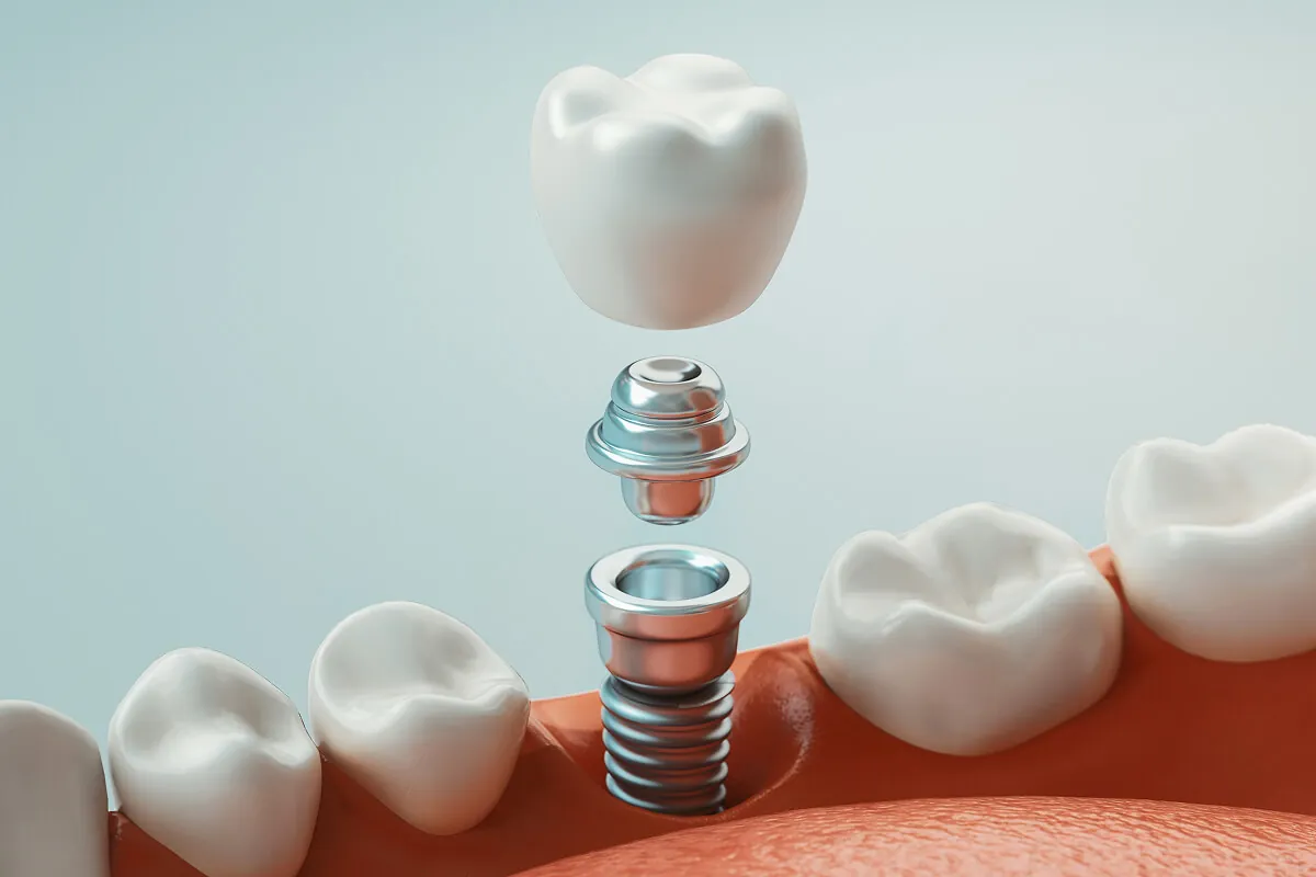 Single dental implant treatment