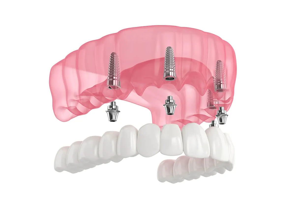All-on-4 dental implant treatment in Cookstown