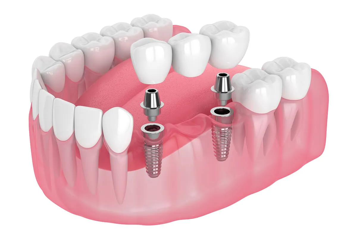 Dental implant bridge treatment