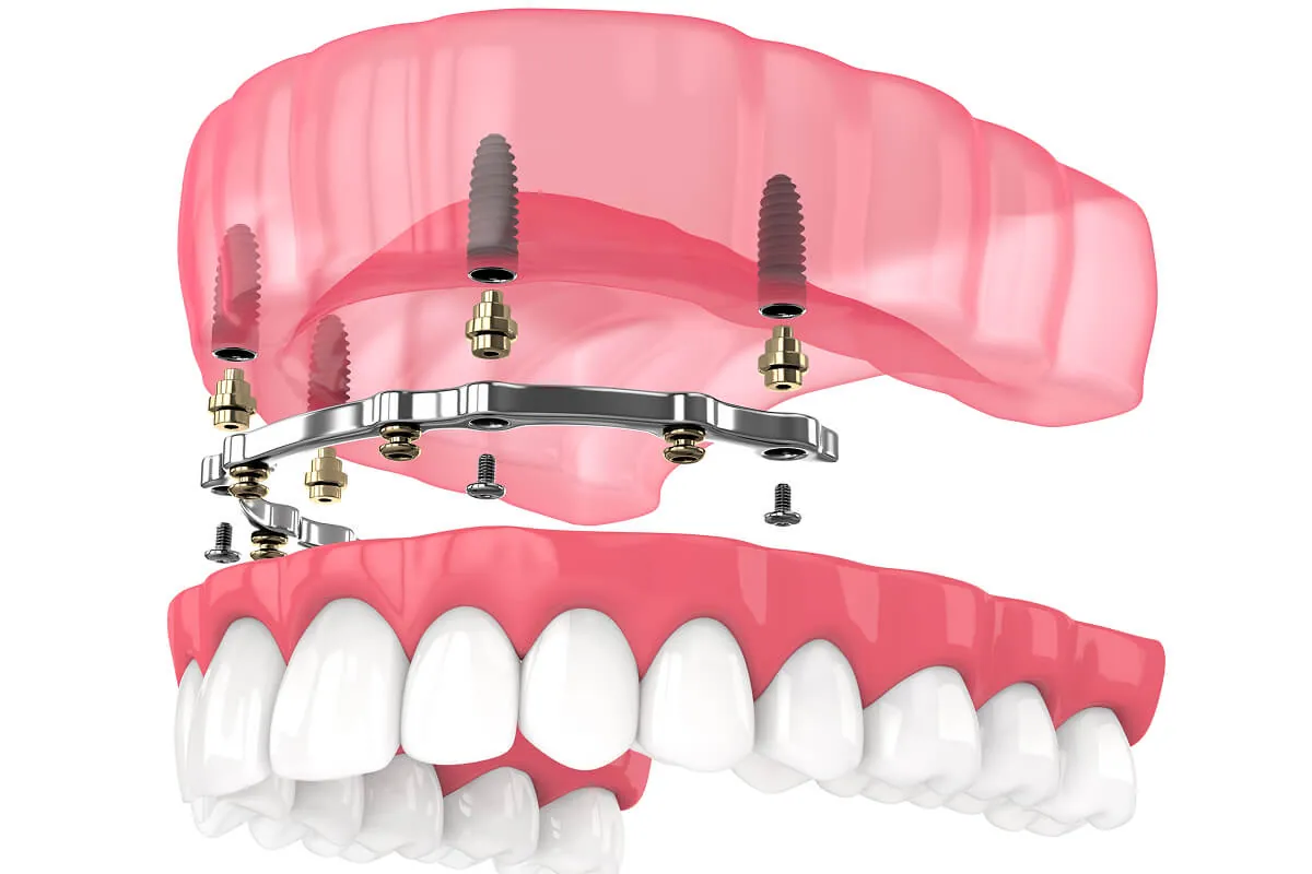 Illustration showing an implant-supported denture system