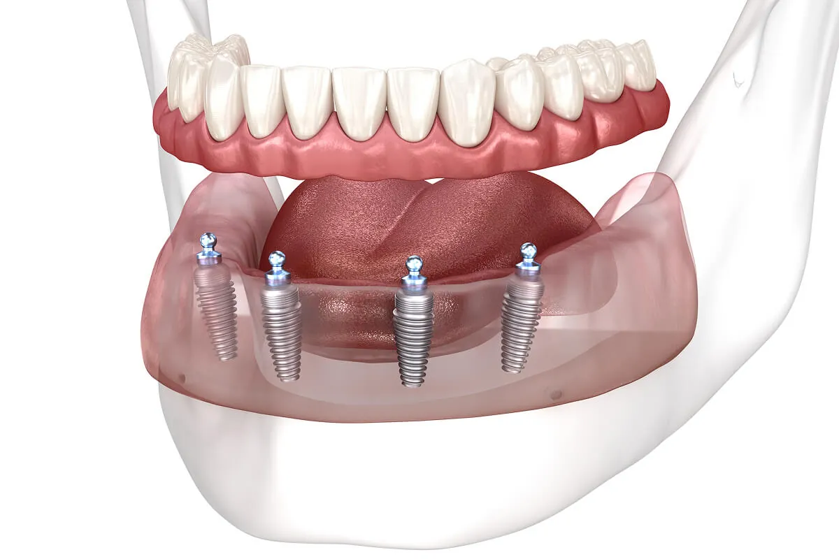 Illustration of a lower implant-supported denture