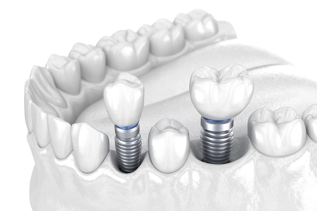 Multiple dental implants in Cookstown
