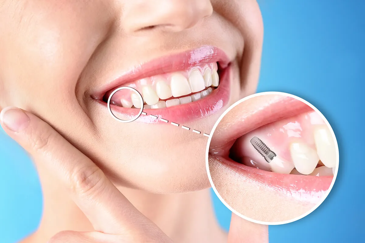 Multiple dental implants near you