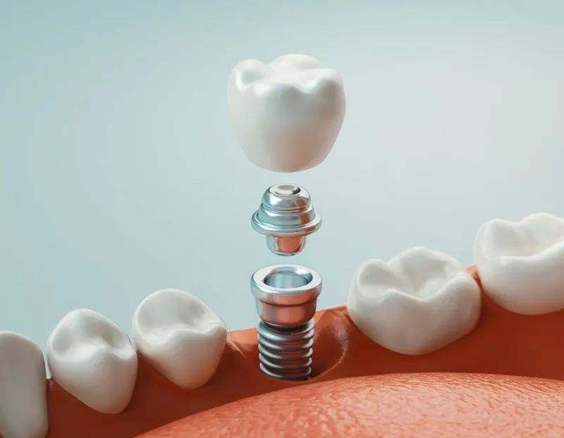 Natural-looking single dental implant