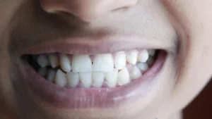 Read more about the article What Are Veneers for Teeth Gaps?